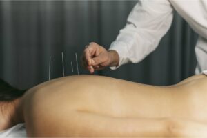 acupuntura